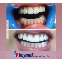 BEYOND  Beyazlatma Ofis Tipi Max 5 set  Minimum 10   -Maximum 15   Hasta içindir 