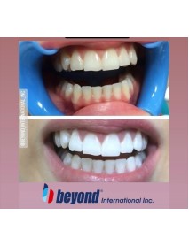 BEYOND  Beyazlatma Ofis Tipi Max 5 set  Minimum 10   -Maximum 15   Hasta içindir 