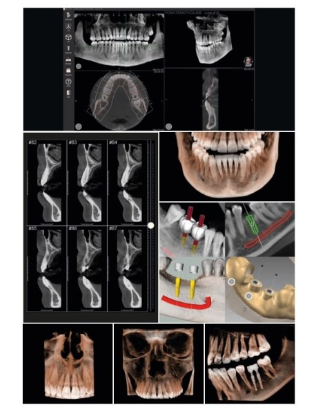 X LINE TOMOGRAFİ CİHAZI   FOV   11X 10
